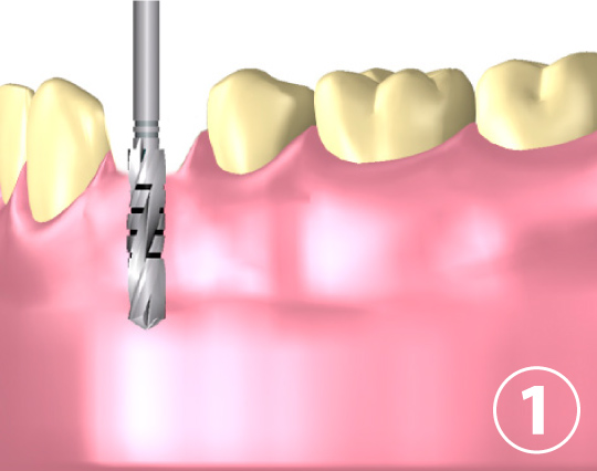 インプラントを入れるアゴの骨に穴を開ける