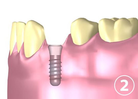 インプラントを埋め込む