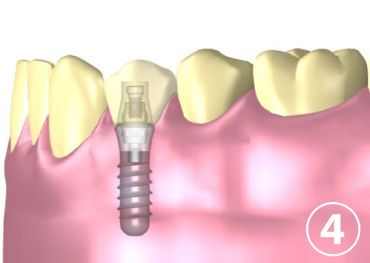 インプラントに人工の歯を装着