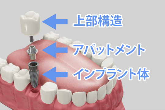 インプラントの構造